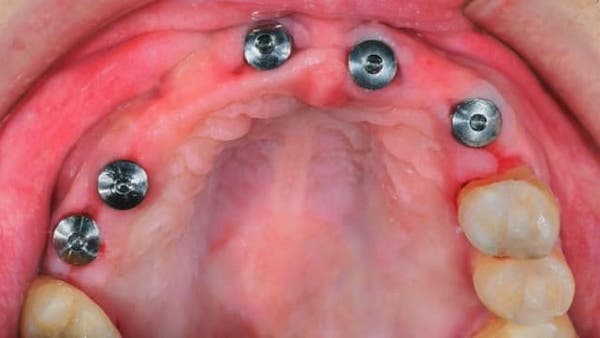 5-implants-placed-in-upper-jaw-for-snap-in-denture