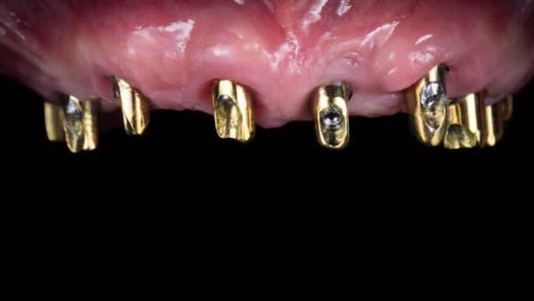 8-implants-placed-in-upper-jaw-for-dentures-with-implants