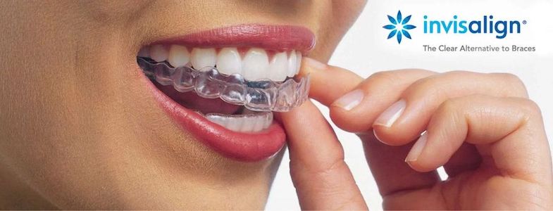 How-Much-Does Invisalign-Cost Without-Insurance-Coverage