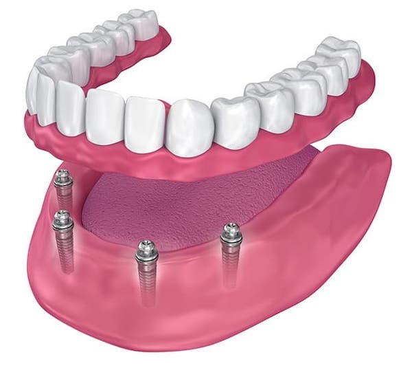 all-on-4-dental-implants-cost