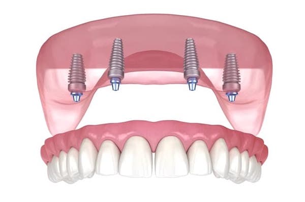 all-on-4-dental-implants-los-angeles