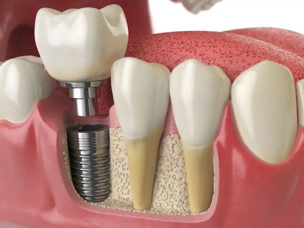are-dental-implants-worth-it-in-los-angeles