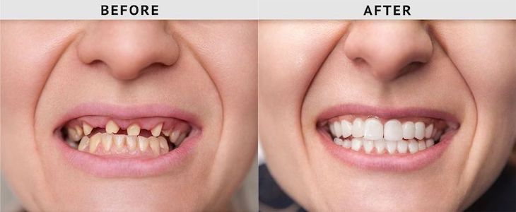 before-and-after-dental-implant-los-angeles