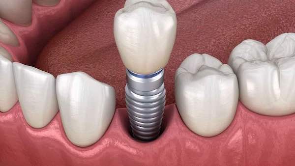benefits-of-dental-implants-los-angeles