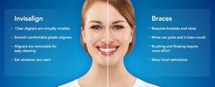 braces-vs-invisalign-for-adults-and-kids-which-one-is-better