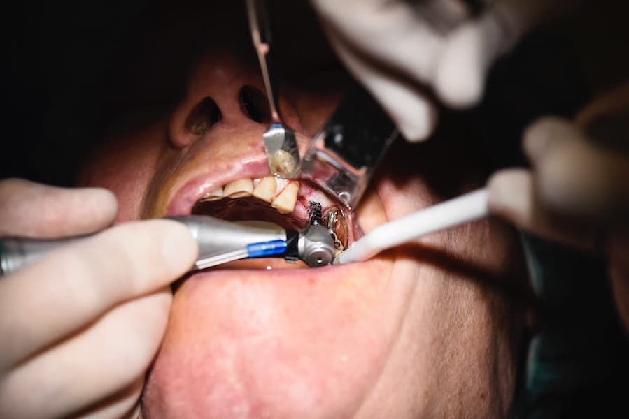 cost-full-mouth-implants-procedure