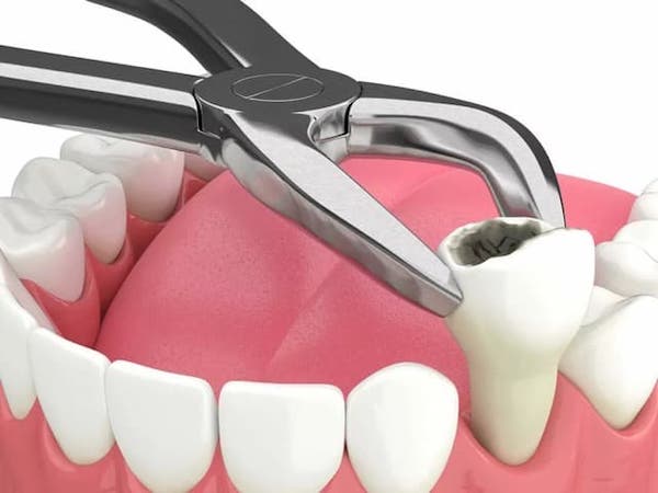 cost-tooth-extraction-dental-clinic-la