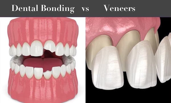dental-bonding-vs-veneers-la
