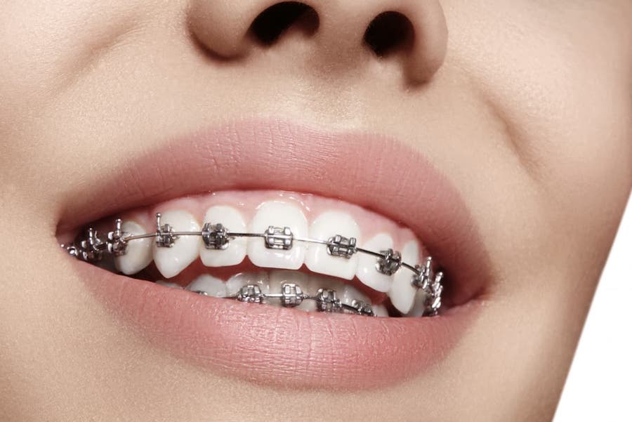 dental-braces-at-the-best-orthodontist-in-los-angeles