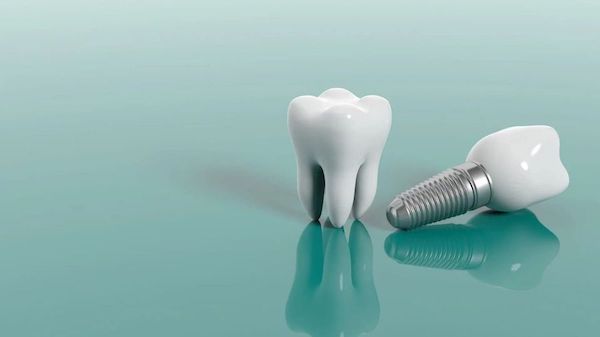 dental-implant-la