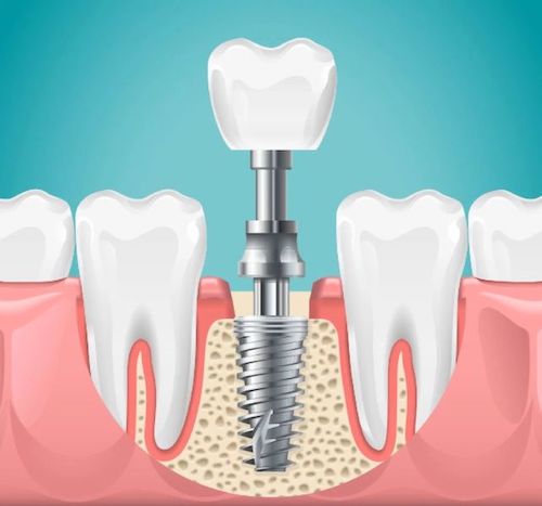 dental-implant-placement-in-the-jaw