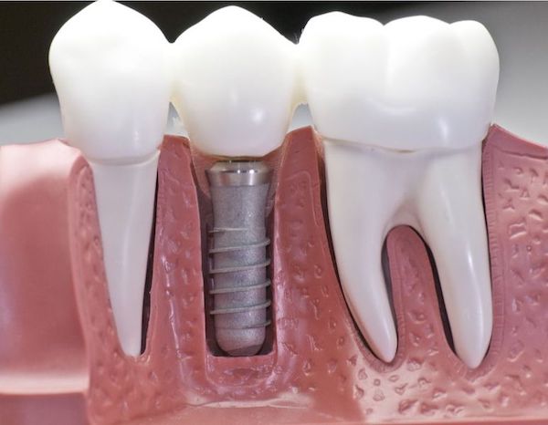 dental-implant-vs-bridge