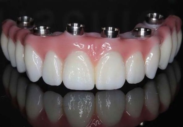 dental-implant-with-dentures-los-angeles