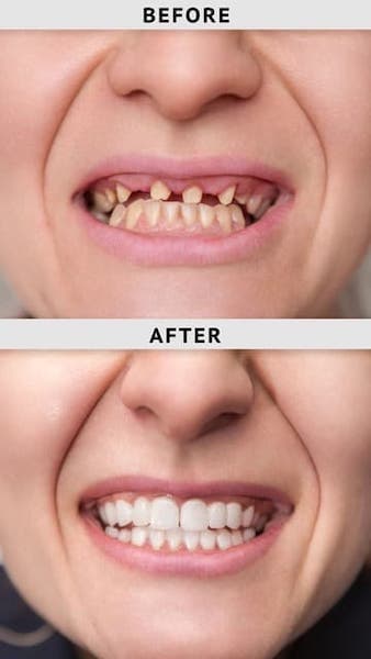 dental-implants-before-after-los-angeles