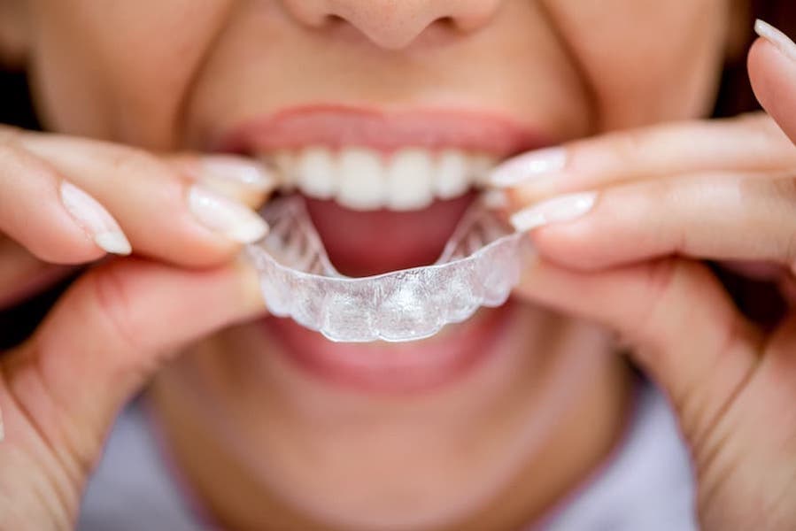 dental-night-mouth-guard-for-grinding
