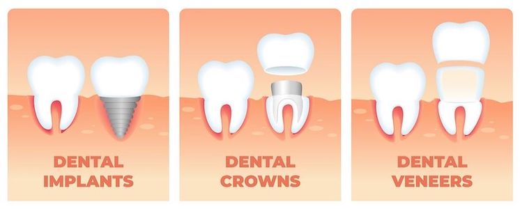 dental-veneer-vs-crown-vs-implant