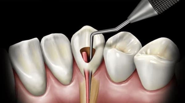 endodontic-treatment-with-gutta-percha