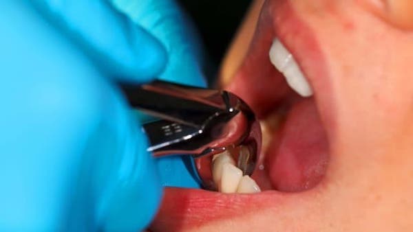 front-tooth-extraction-in-los-angeles
