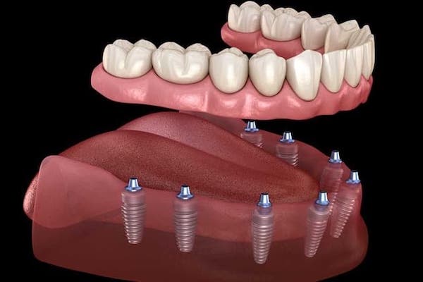 full-mouth-dental-implant-reconstruction-los-angeles