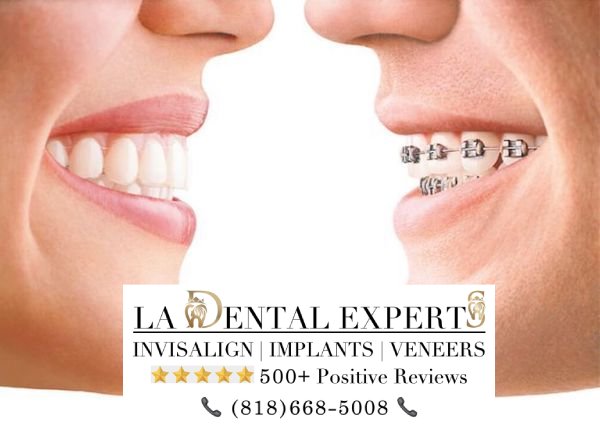 invisalign-braces-los-angeles-how-they-work