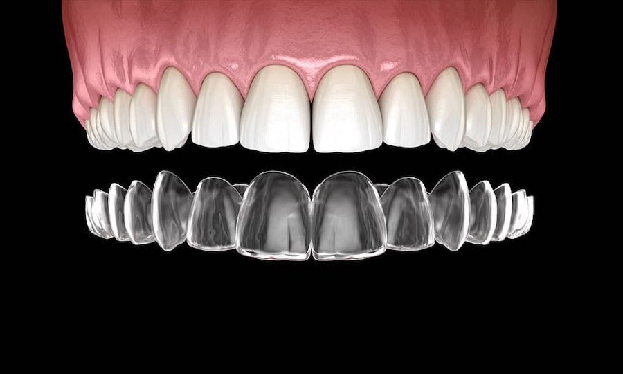 invisalign-cost-without-insurance-los-angeles