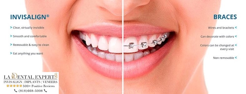 invisalign-vs-braces-which-one-is-better