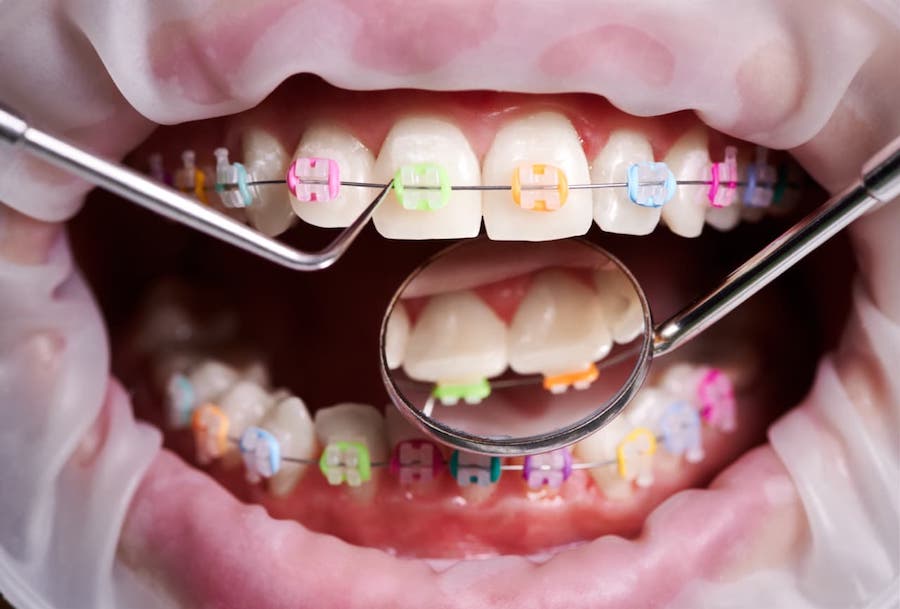 la-orthodontist-examining-patient-braces-with-dental-mirror