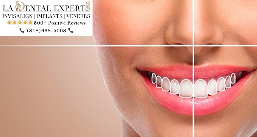 los-angeles-cosmetic-dentist-near-me-smiling-after-veneers-and-implants