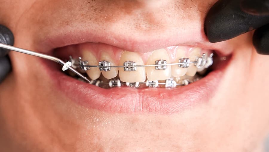 los-angeles-orthodontist-working-on-dental-braces