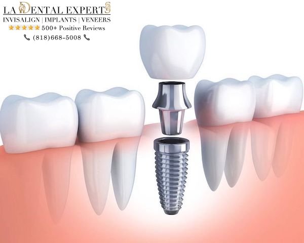 lower-tooth-dental-implant-los-angeles