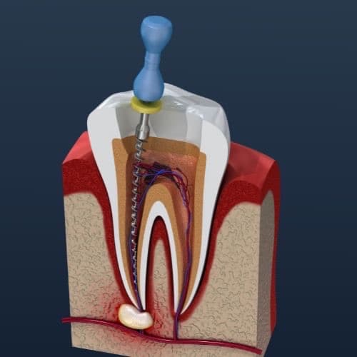 molar-tooth-root-canal-treatment-los-angeles