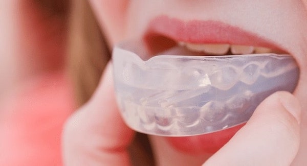 mouth-guard-los-angeles