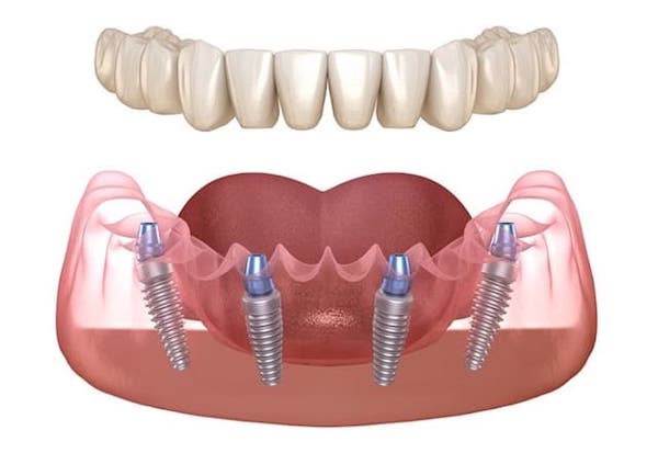 price-of-all-on-4-dental-implants-in-los-angeles
