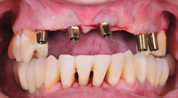 replacing-top-6-front-teeth-with-dental-implants-and-bridge-los-angeles