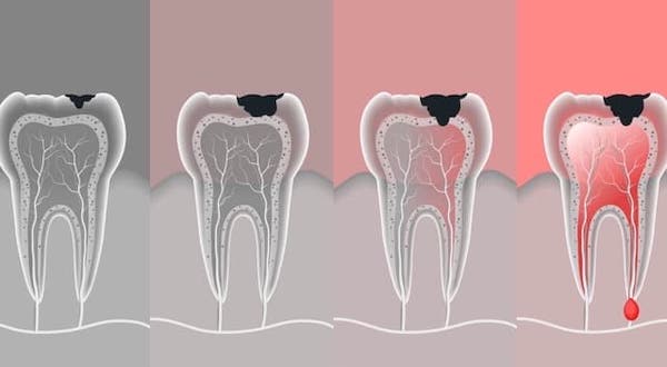 root-canal-treatment-of-lower-molar