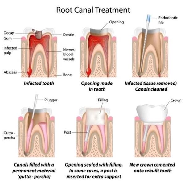 root-canal-treatment-steps