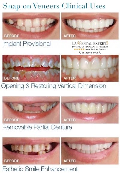 snap-on-smile-veneers-before-and-after