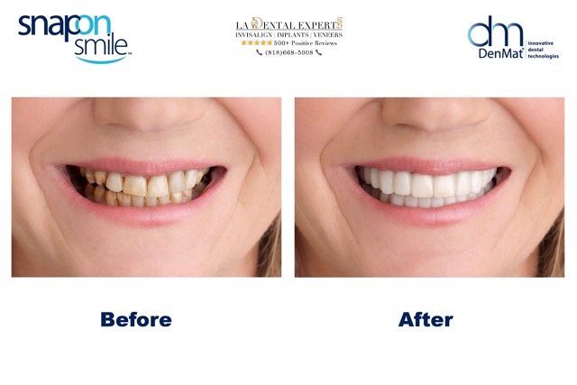 snap-on-veneers-before-and-after-los-angeles