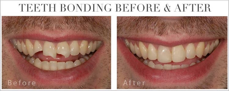 teeth-bonding-before-and-after