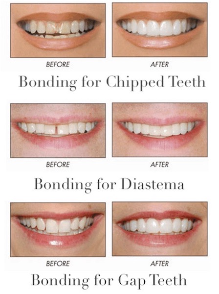 teeth-bonding