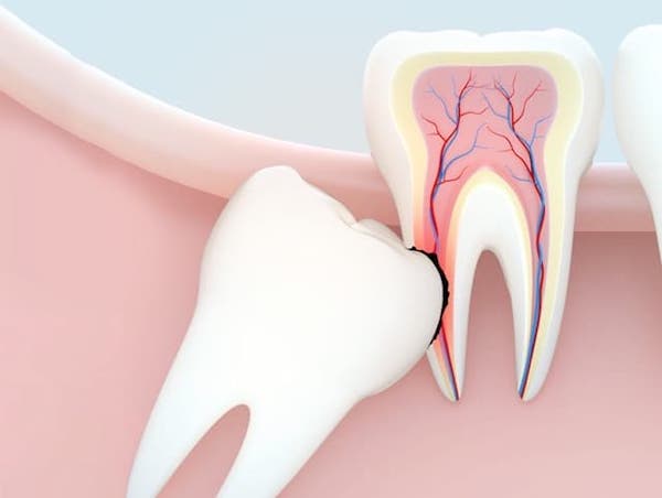 wisdom-tooth-extraction-los-angeles