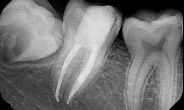 xray-after-root-canal-treatment