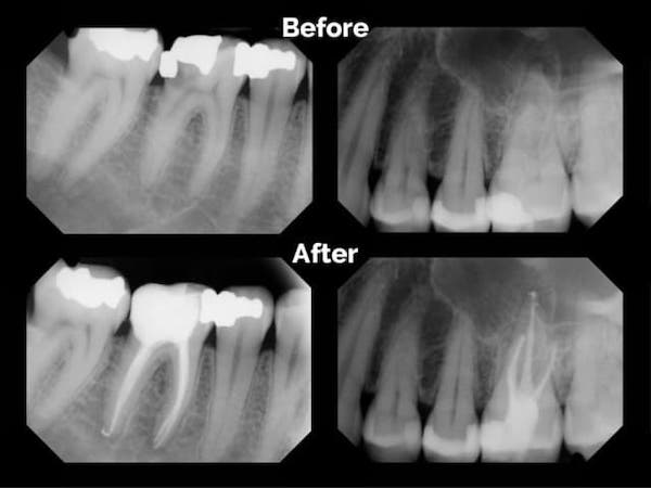 xray-before-after-root-canal-treatment