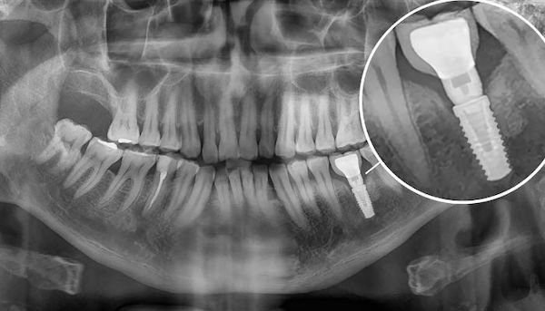 xray-of-lower-dental-implant-cost-after-surgery