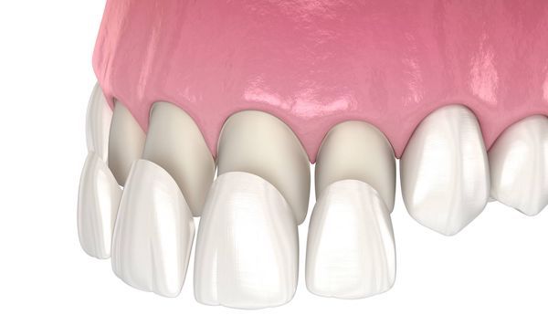 6-front-dental-veneers-cost