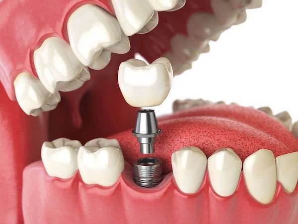 best-dental-implants-los-angeles-pricing