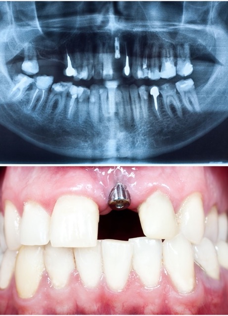 cost-of-dental-implants-and-xray