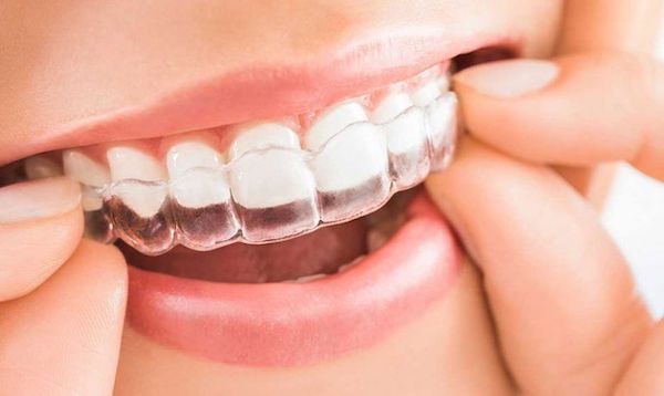 cost-of-invisalign-teen-los-angeles