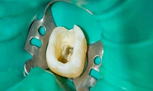 dental-dam-before-root-canal-treatment-cost