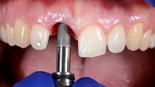 dental-implant-placement-surgery-price